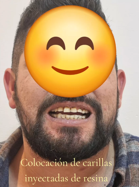Resultado de tratamiento dental caso 2 primera vista en Aletan