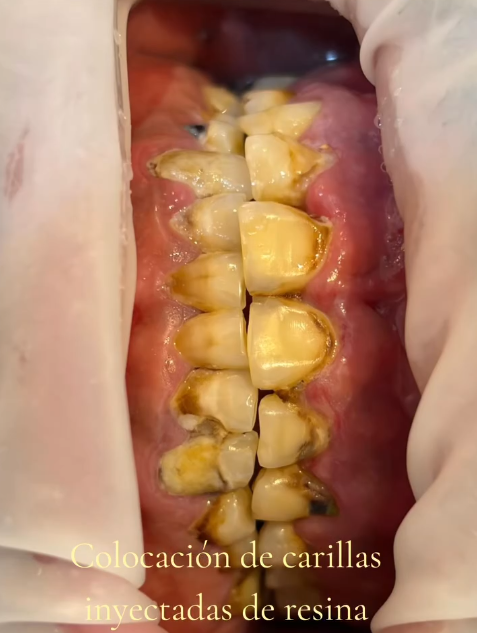 Resultado de tratamiento dental caso 2 segunda vista en Aletan