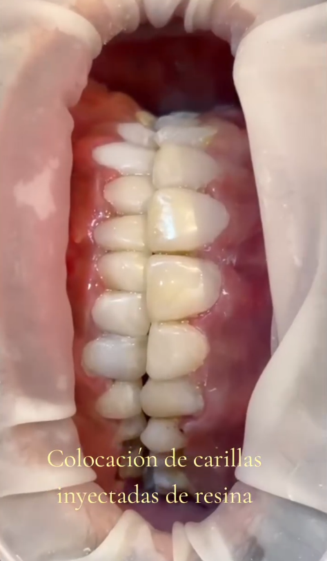 Resultado de tratamiento dental caso 2 tercera vista en Aletan