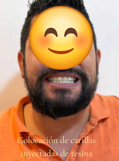 Resultado de tratamiento dental caso 2 cuarta vista en Aletan