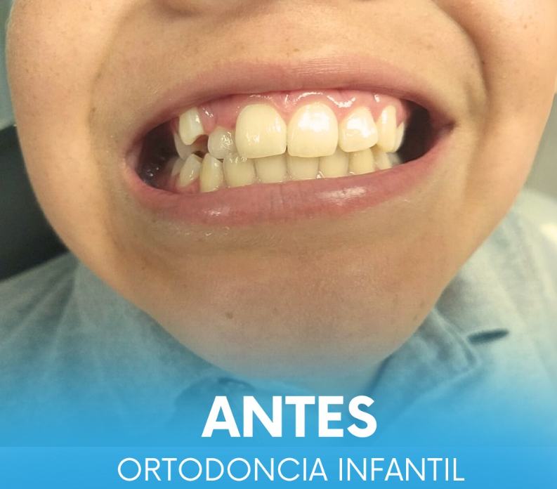 Resultado de tratamiento dental caso 3 primera vista en Aletan