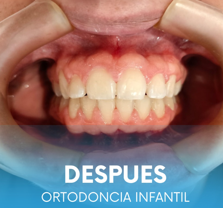 Resultado de tratamiento dental caso 3 segunda vista en Aletan